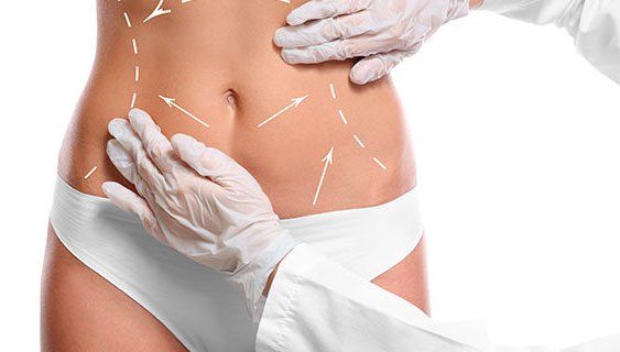 abdominoplasty