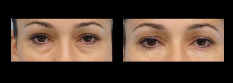 blepharoplasty in mexico
