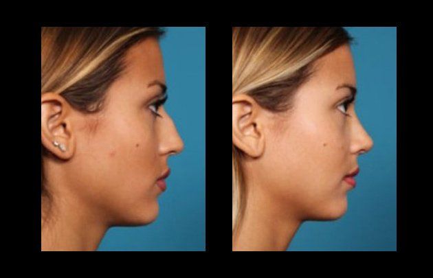 facial lipofilling in mexico