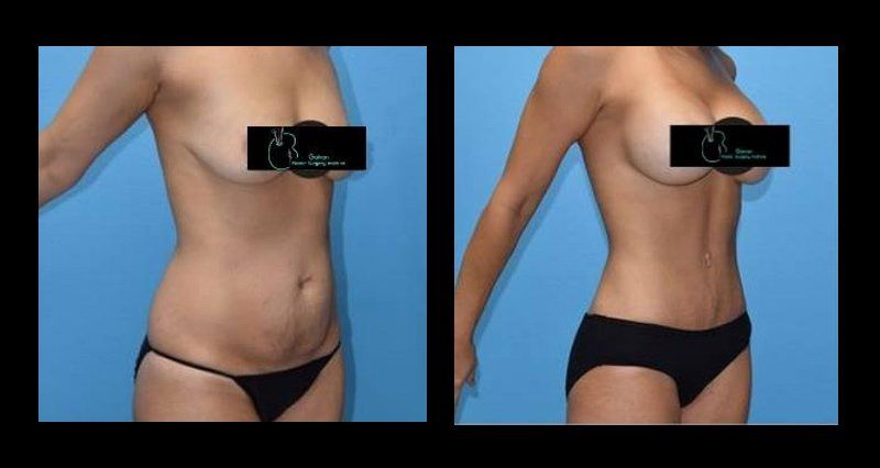 liposuction in mexico