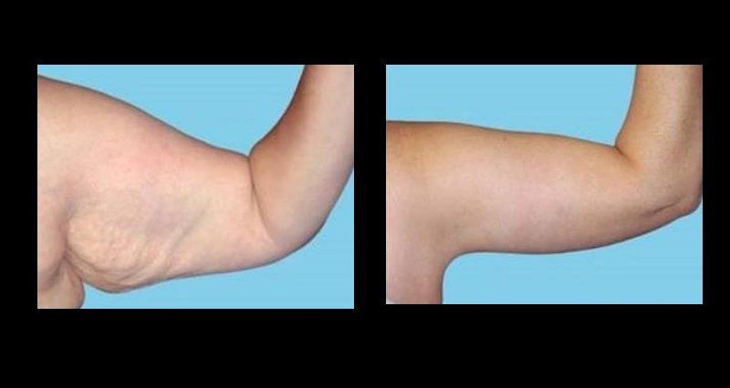 liposuction in mexico