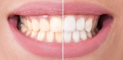 Teeth whitening