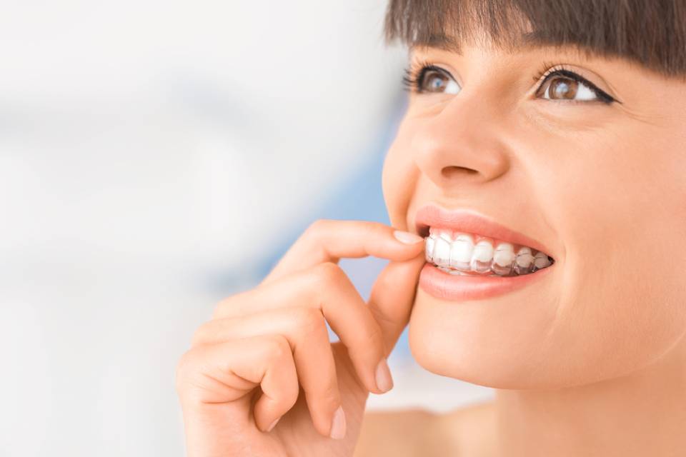 apparecchio ortodontico invisalign