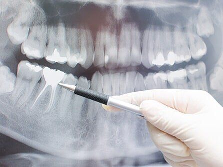 Dental X-Ray - Root Canals in Lynbrook, NY