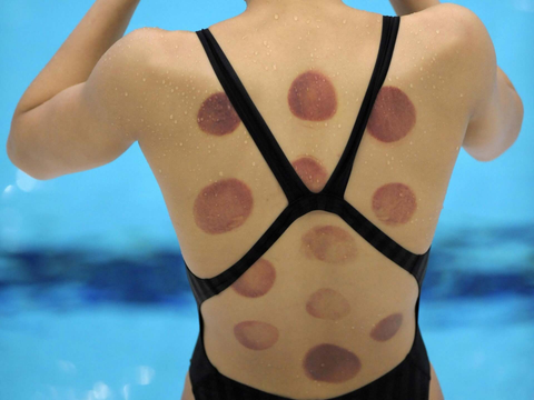 olympic_swimmer_cupping