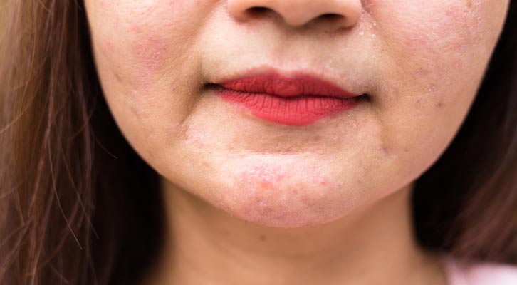 Eczema Treatments NYC by Marc Bystock L.Ac.