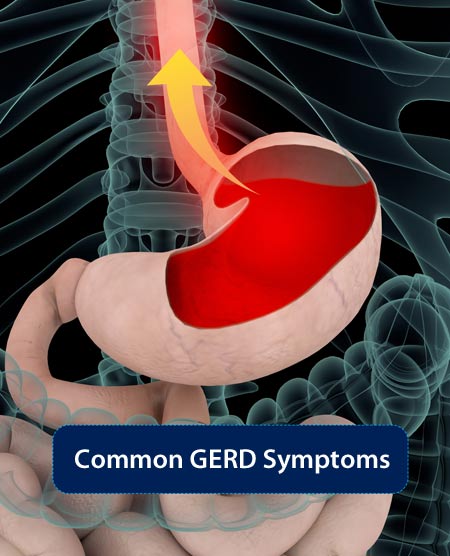 Licensed Acupuncturist Marc Bystock Treating GERD, Heartburn, and Acid Reflux in Midtown Manhattan NY 10016