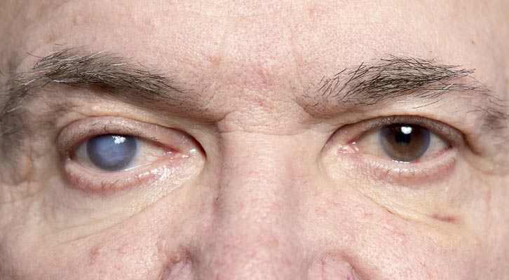 Glaucoma Treatment NYC by Marc Bystock L.Ac.