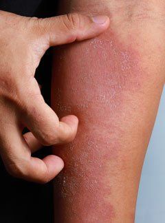 Marc Bystock, NYC Eczema Acupuncturist in Midtown Manhattan NY 10016