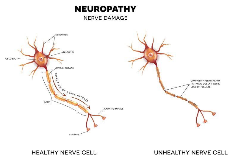 Neuropathy Nerve Damage. Click to Enlarge NYC Neuropathy Acupuncture Treatment by Marc Bystock in Midtown Manhattan NY 10016