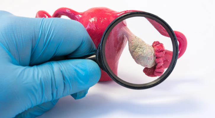 Polycystic Ovarian Syndrome Treatment NYC by Marc Bystock L.Ac.
