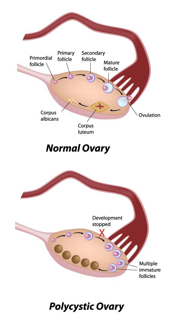 Treatments for PCOS by NYC Acupuncturist in Midtown Manhattan NY 10016