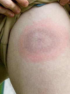 Treatment for Lyme Disease by Marc Bystock NYC Acupuncturist in Midtown Manhattan NY