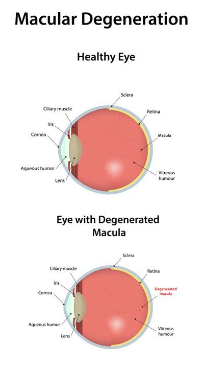 Click to Enlarge Treatments for Macular Degeneration by Marc Bystock NYC Acupuncturist in Midtown Manhattan