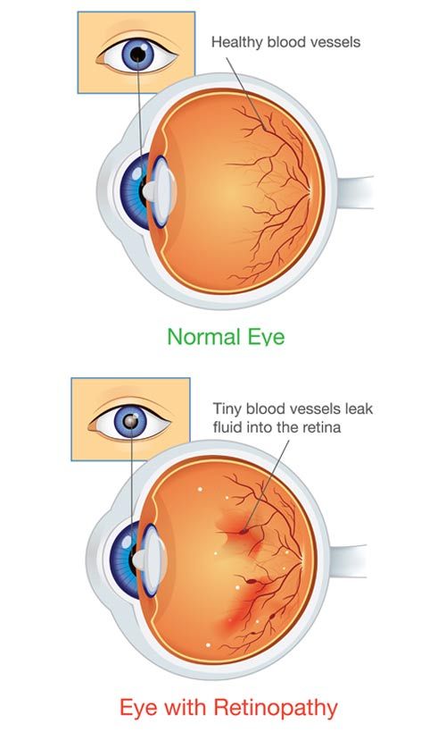 Click to Enlarge Acupuncture for Diabetic Retinopathy by Marc Bystock NYC Acupuncturist in Midtown Manhattan NY 10016
