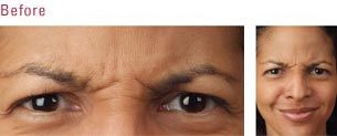 Vpeel — Women Before Botox in Wellington, FL