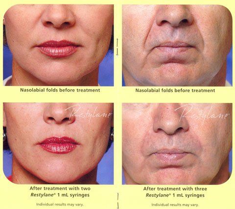 Dermatology — Women and Men Face after Restylane in Wellington, FL