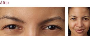 Facial — Women After Botox in Wellington, FL