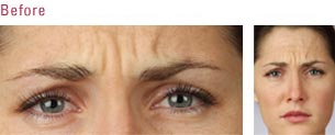 Ultherapy — Pretty Women Before Botox in Wellington, FL