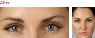 Micrographic Surgery— Pretty Women After Botox in Wellington, FL