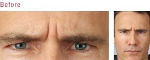 Photorejuvenation— Forehead of Guy Before Botox in Wellington, FL