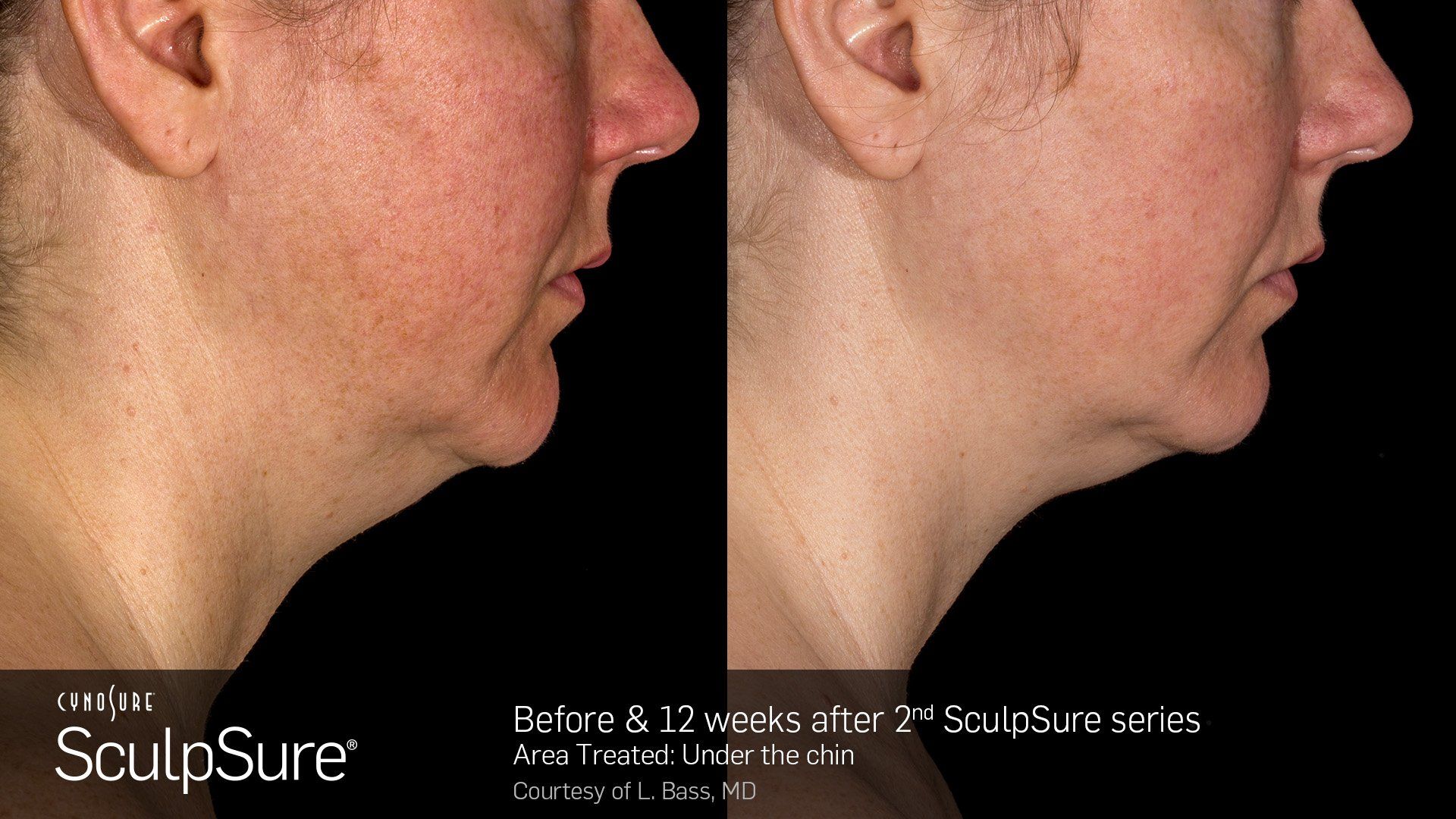 Dermatology Center Of Wellington  Microblading — Woman with Pointed Nose in Wellington, FL