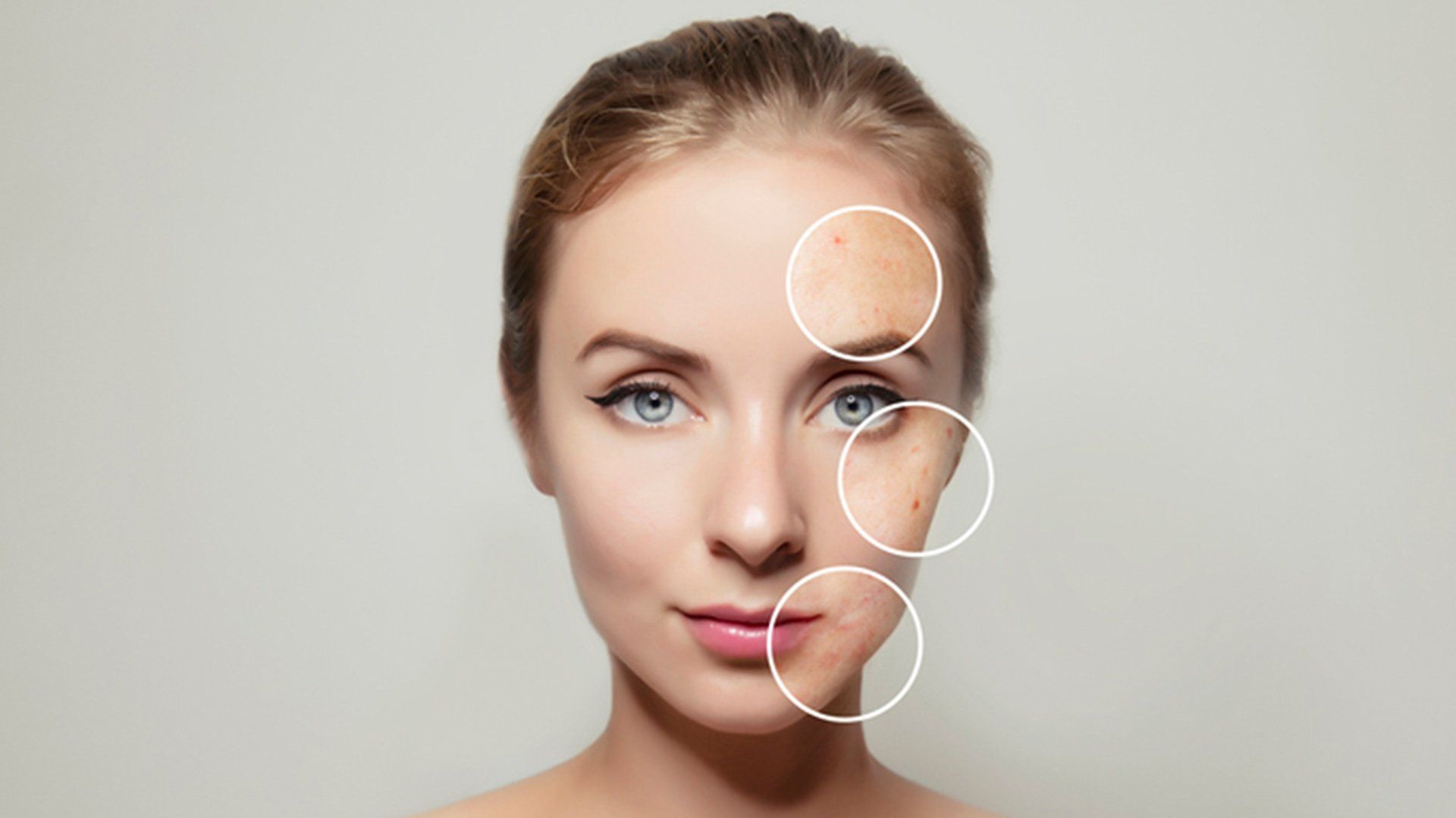 Skin Acne — Voorhees, NJ — Bennett K. Schwartz, M.D.