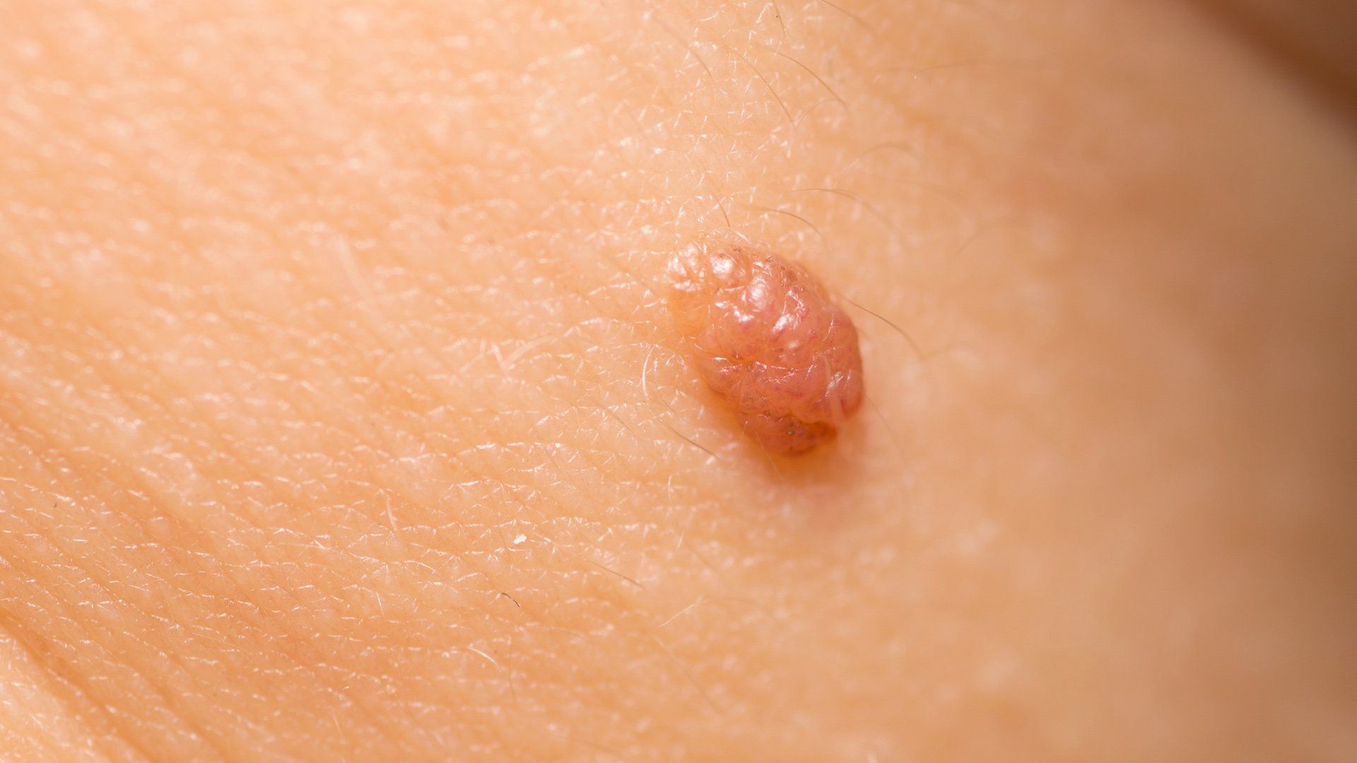 Skin Growth — Voorhees, NJ — Bennett K. Schwartz, M.D. Skin Growth — Voorhees, NJ — Bennett K. Schwartz, M.D.