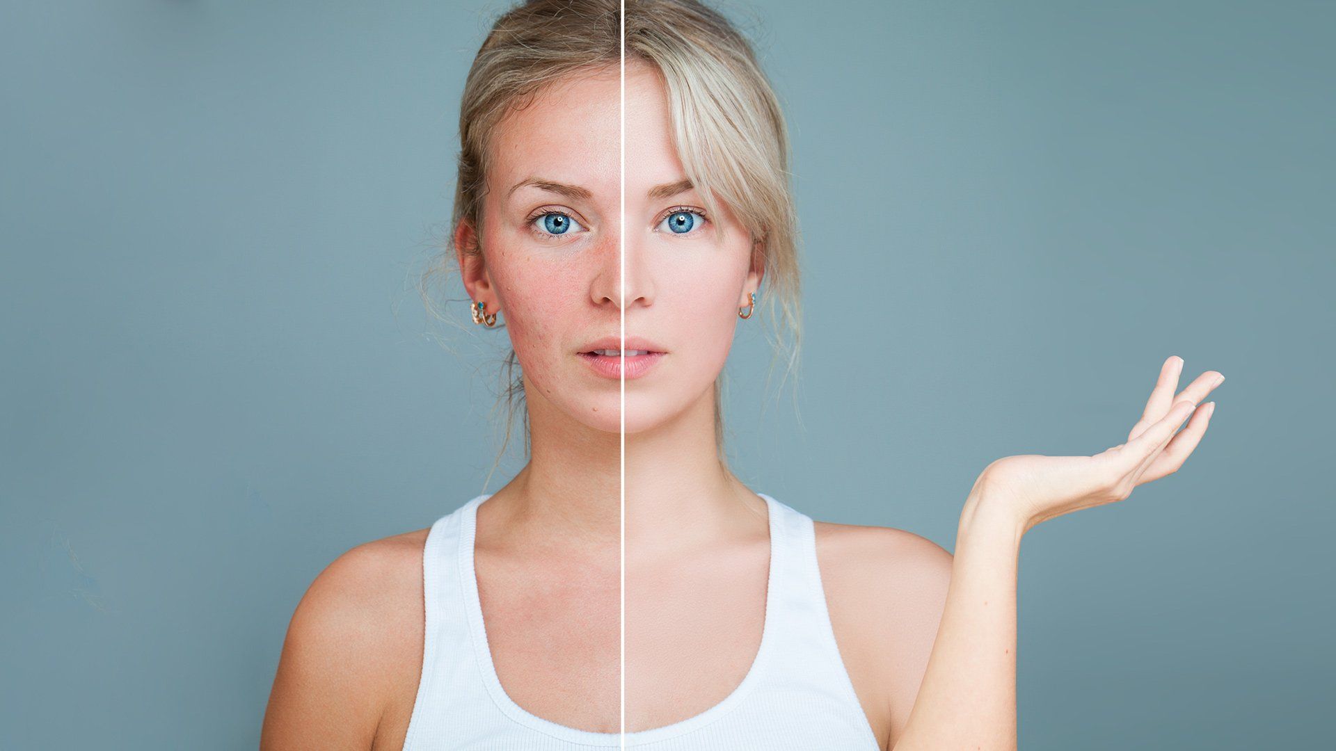 Before And After Rosacea Treatment — Voorhees, NJ — Bennett K. Schwartz, M.D. Before And After Rosacea Treatment — Voorhees, NJ — Bennett K. Schwartz, M.D.