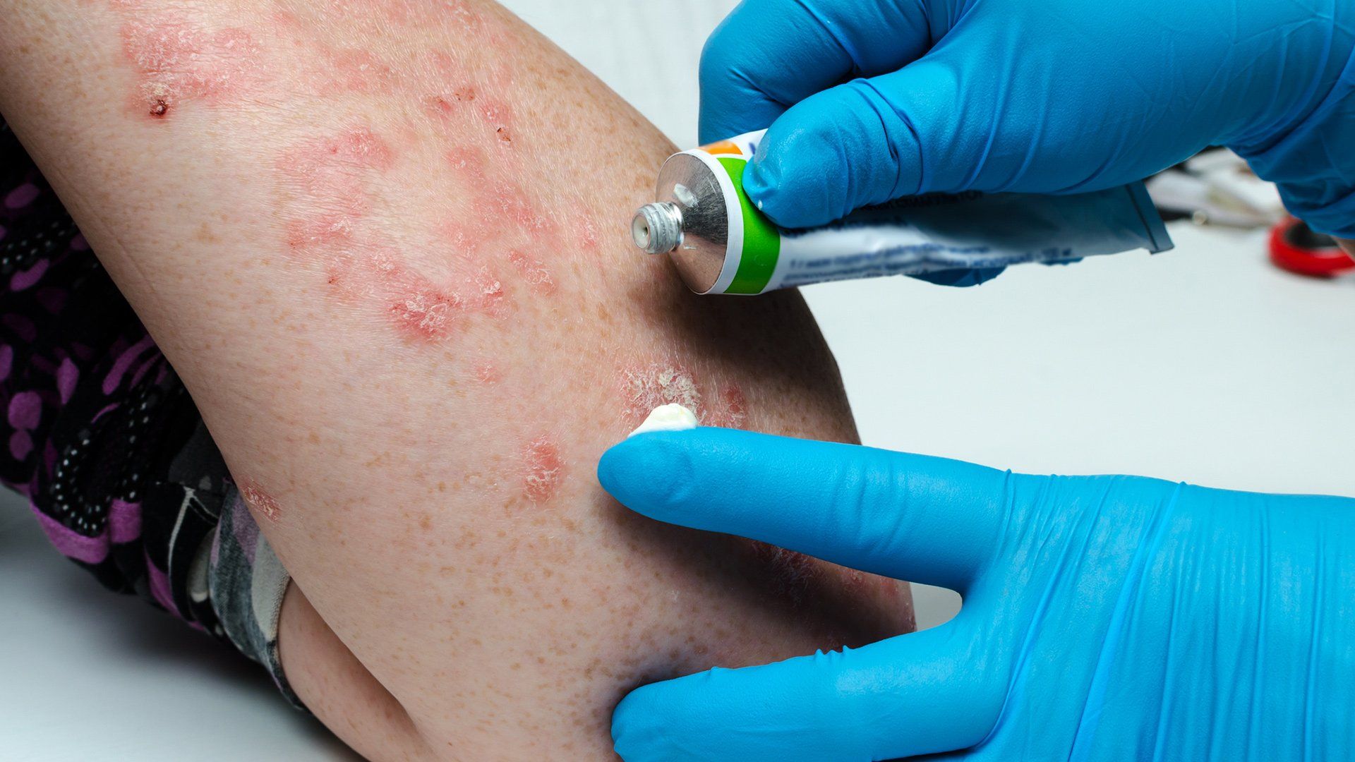 Applying Skin Ointment — Voorhees, NJ — Bennett K. Schwartz, M.D.