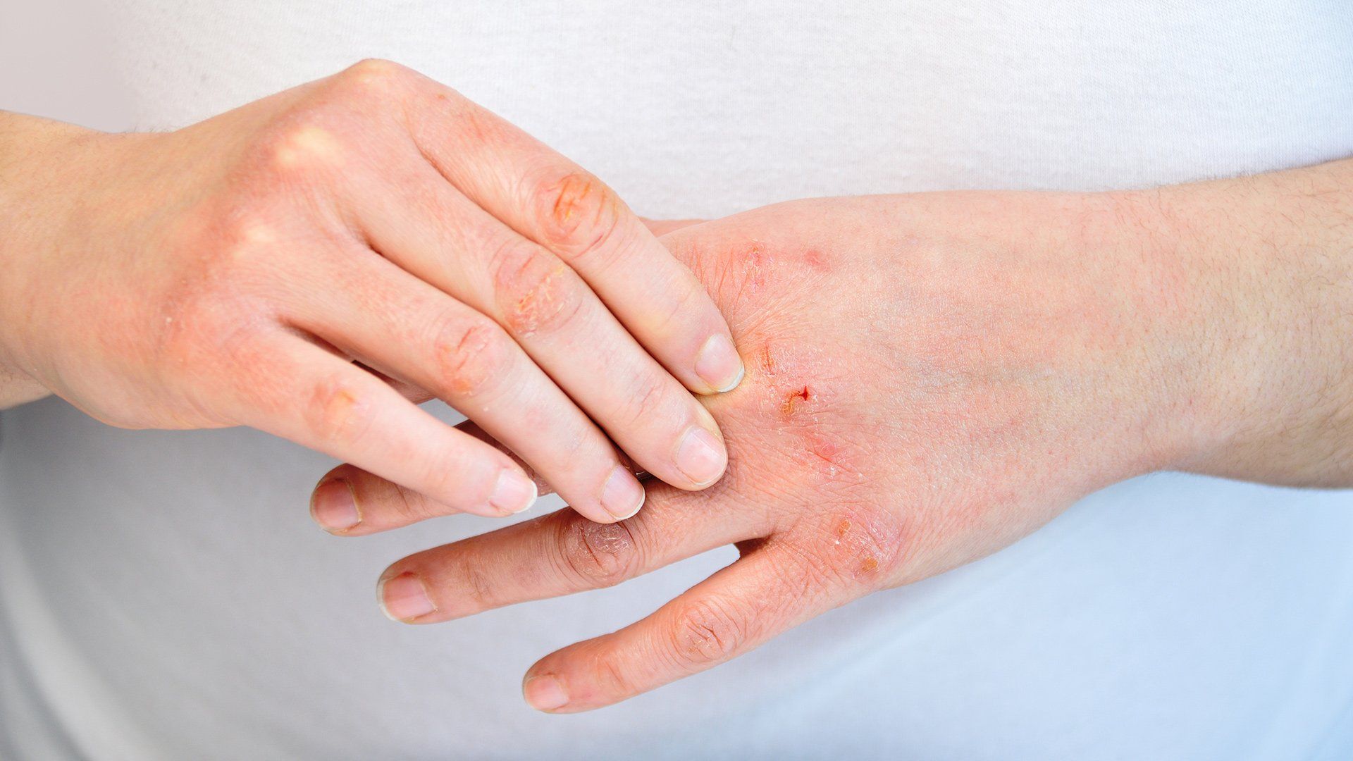 Dermatitis — Voorhees, NJ — Bennett K. Schwartz, M.D. Dermatitis — Voorhees, NJ — Bennett K. Schwartz, M.D.
