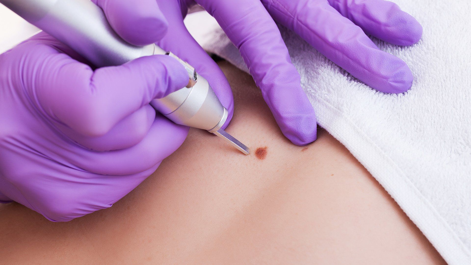 Mole Skin Treatment — Voorhees, NJ — Bennett K. Schwartz, M.D. Mole Skin Treatment — Voorhees, NJ — Bennett K. Schwartz, M.D.