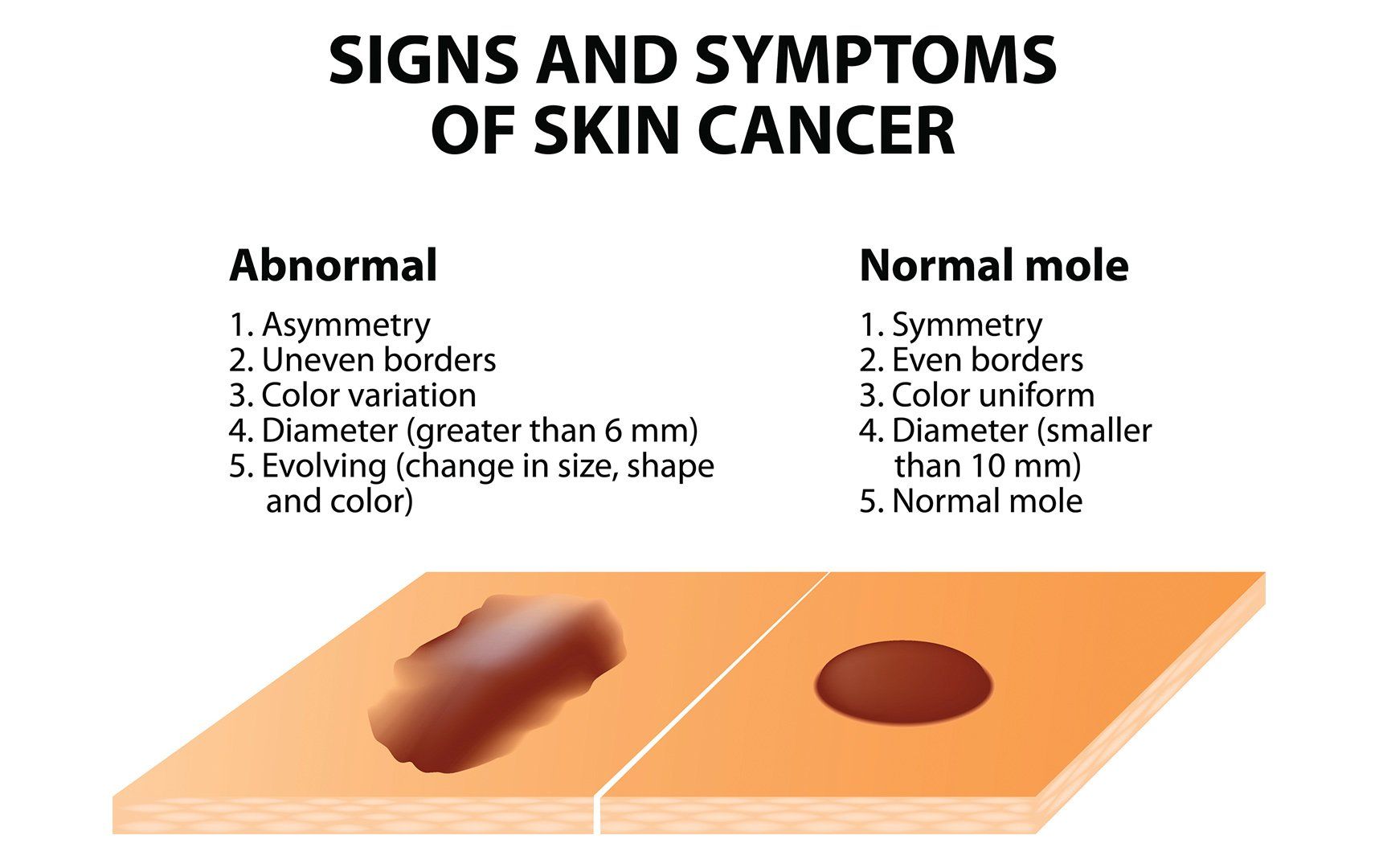 Sign And Symptoms Of Skin Cancer — Voorhees, NJ — Bennett K. Schwartz, M.D. Sign And Symptoms Of Skin Cancer — Voorhees, NJ — Bennett K. Schwartz, M.D.