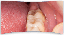 Inside view of someone's lower back jaw showing a cosmetic crown