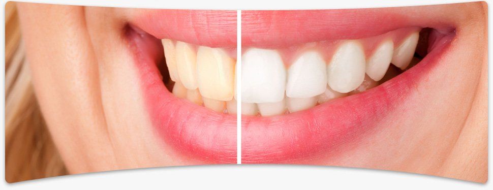 Want to get your teeth whitened? Book your appointment and call on 01905 23808 Merged image of a womans smile showing the effects of teeth whitening