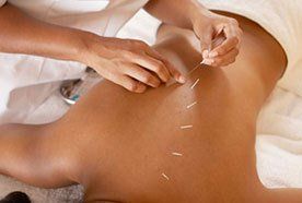 Acupuncture needles being inserted into a patient's back