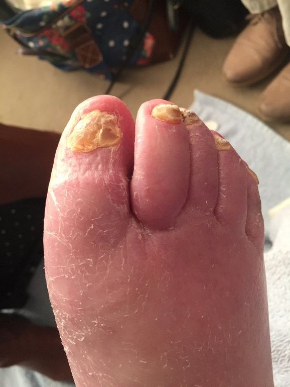 These nails are growing upside down due to constant use of pressure stockings.