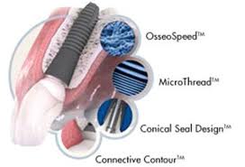 Astra Tech dentālais implants