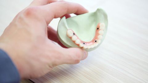 Kunstgebit op implantaten Kunstgebit op implantaten klikgebit
