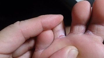 athletes foot