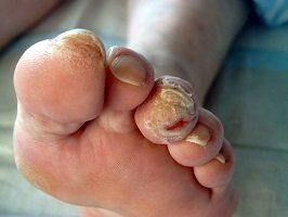 diabetic feet