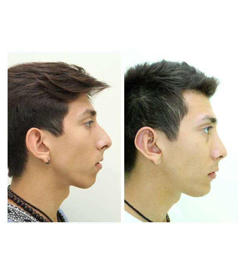 mentoplastia antes y despues