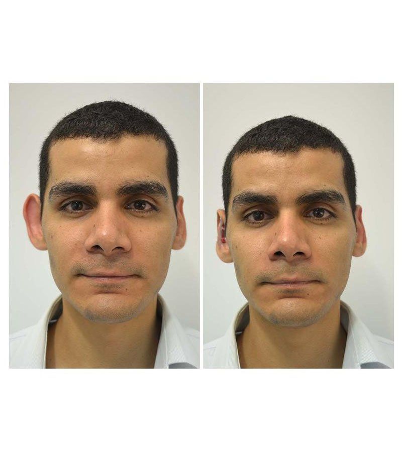 otoplastia antes y despues