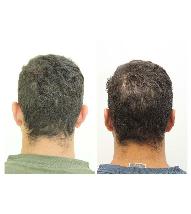 otoplastia antes y despues