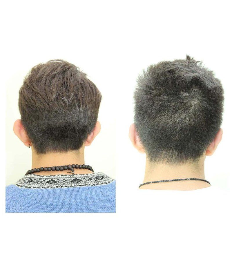 otoplastia antes y despues
