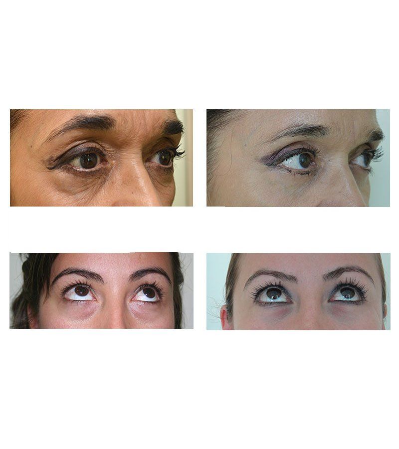 blefaroplastia antes y despues