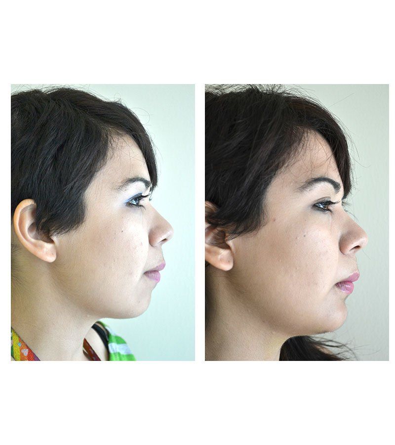 mentoplastia antes y despues