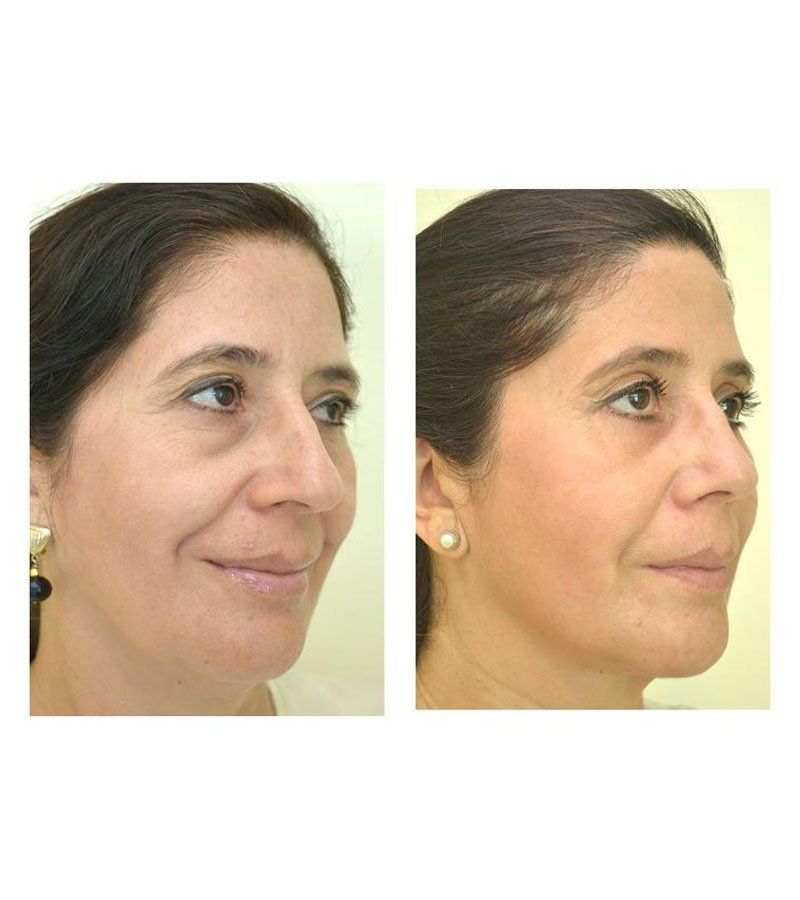 rejuvenecimiento facial Chihuahua