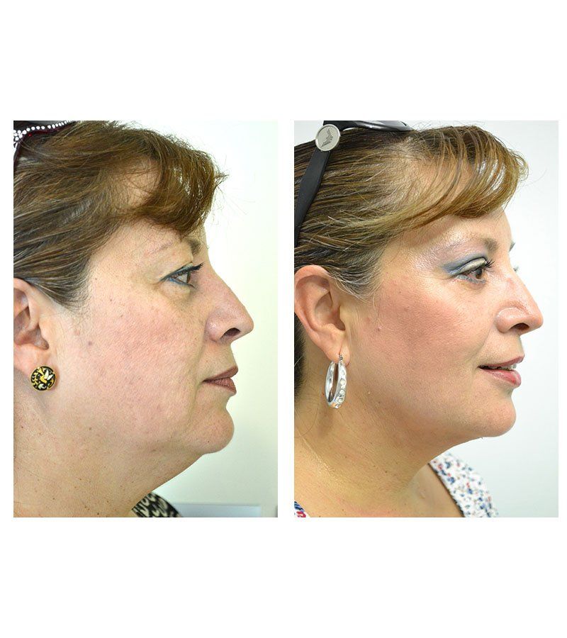 rejuvenecimiento facial Chihuahua