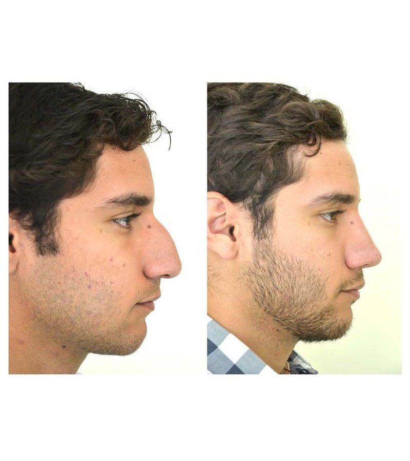 rinoplastia guadalajara